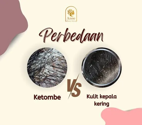 Kulit Kepala Kering vs Ketombe