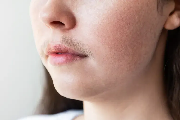 10 Penyebab Hirsutisme pada Wanita dan 6 Tips Mengelolanya