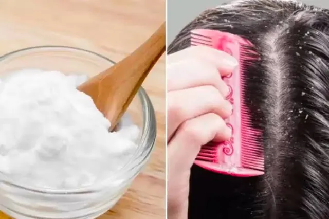 10 Cara Alami Mengatasi Ketombe di Rambut dengan Perawatan Rumahan