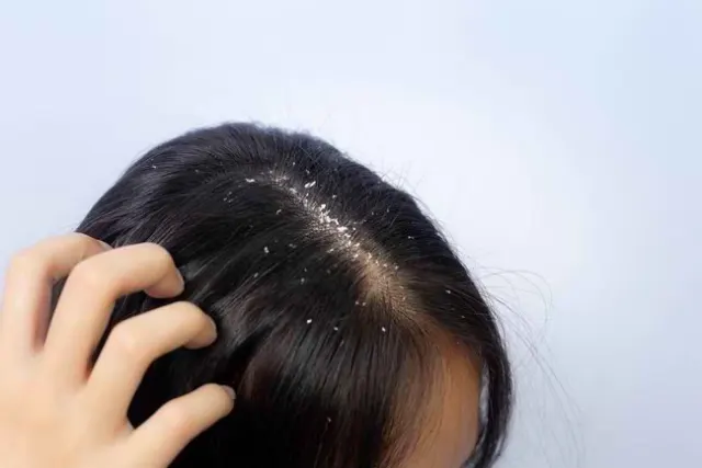6 Perubahan Hormonal Pemicu Ketombe yang Perlu Diketahui