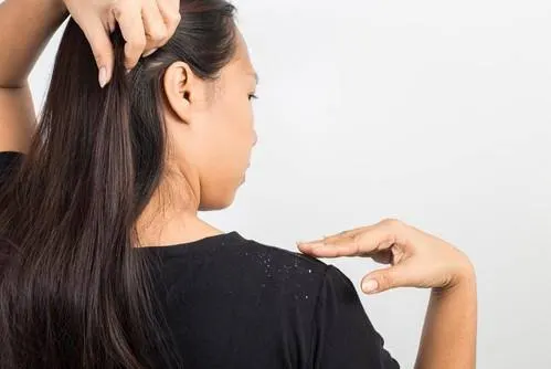 5 Mitos dan Fakta Ketombe yang Perlu Kamu Ketahui